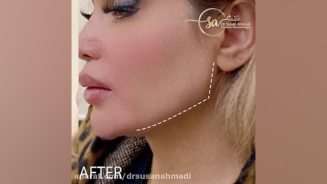 تصحیح عیوب ناشی از تزریق غیراصولی فیلر در ناحیه چانه و زاویه فک دکتر سوسن احمدی پیر شهید
