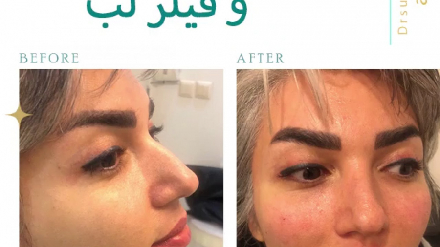 ️تزريق طبیعی چربی و فيلر لب️ دکتر سوسن احمدی پیر شهید