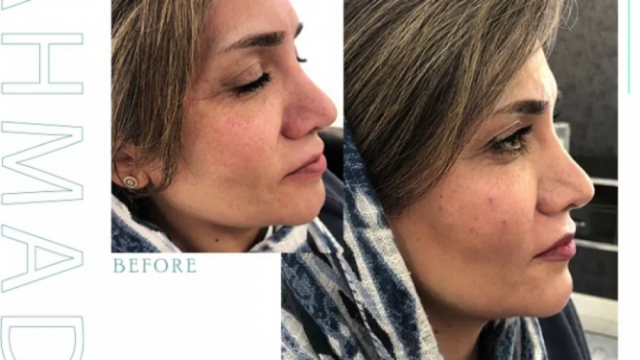 تزریق چربی صورت و زاویه سازی و فرم دهی کامل دکتر سوسن احمدی پیر شهید