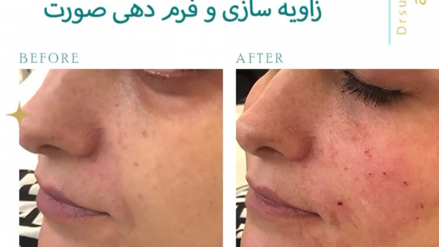تزریق چربی صورت و زاویه سازی و فرم دهی کامل دکتر سوسن احمدی پیر شهید