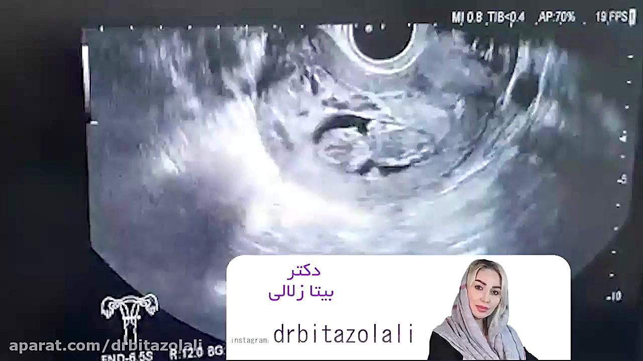 خبر خوب بارداری بعد از پنج سال انتظار آکنه