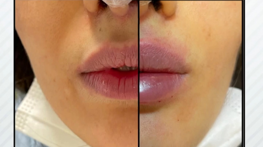 تزریق فیلر لب متناسب با چهره دکتر سار ا لطفی