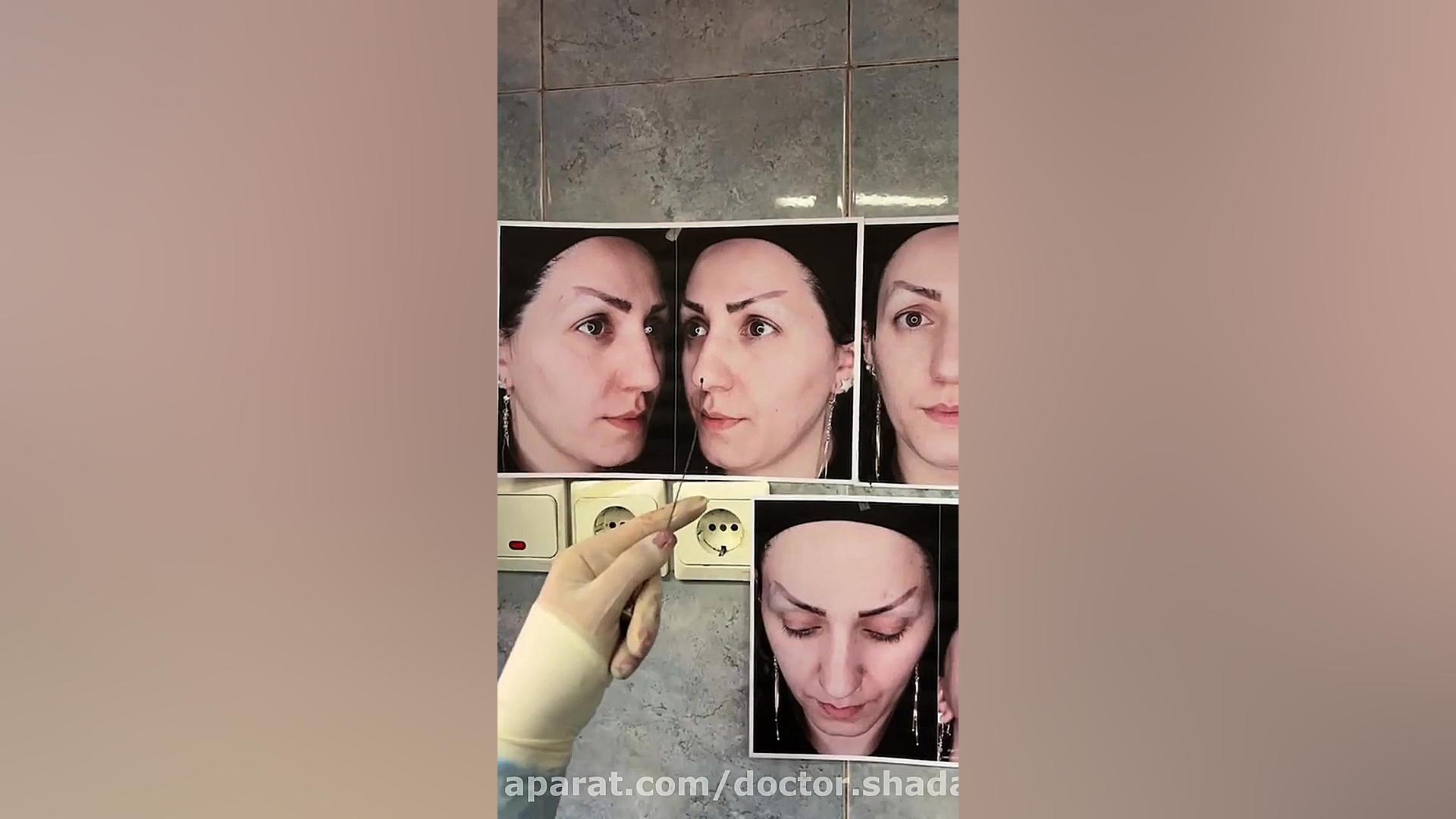 فیلم جراحی بینی گوشتی در اتاق عمل لیپوماتیک