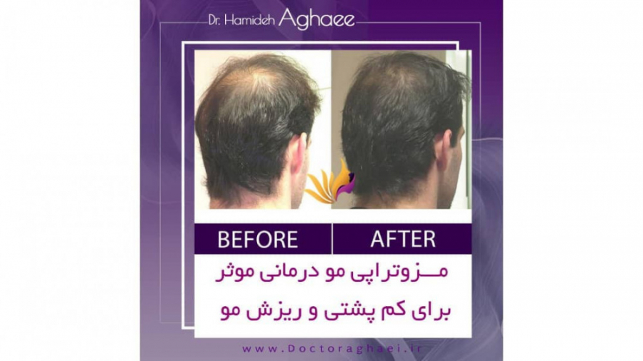 فیلم مزوتراپی مو دکتر حمیده آقایی