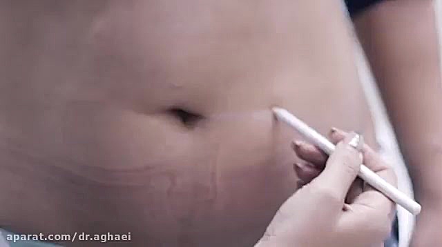 فیلم اندولیفت شکم دکتر حمیده آقایی