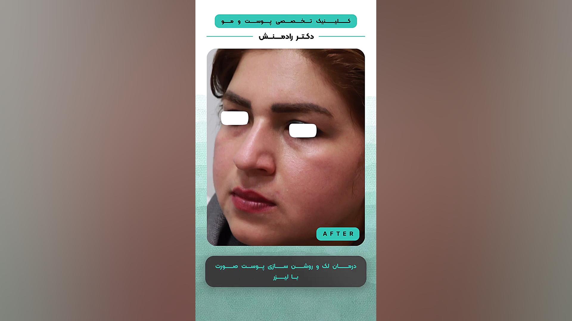 درمان لک و روشن سازی پوست صورت با لیزر ترمیم دندان