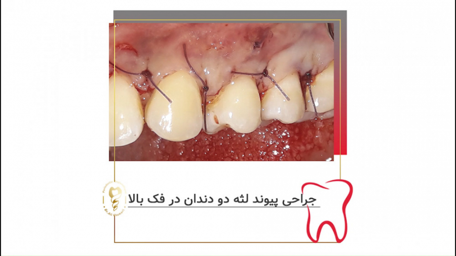 فیلم جراحی پیوند لثه دو دندان در فک بالا دکتر علی قمری - متخصص جراحی لثه و ایمپلنت