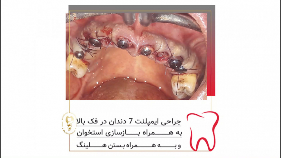 جراحی ایمپلنت ۷ دندان در فک بالا به همراه بازسازی استخوان دکتر علی قمری - متخصص جراحی لثه و ایمپلنت