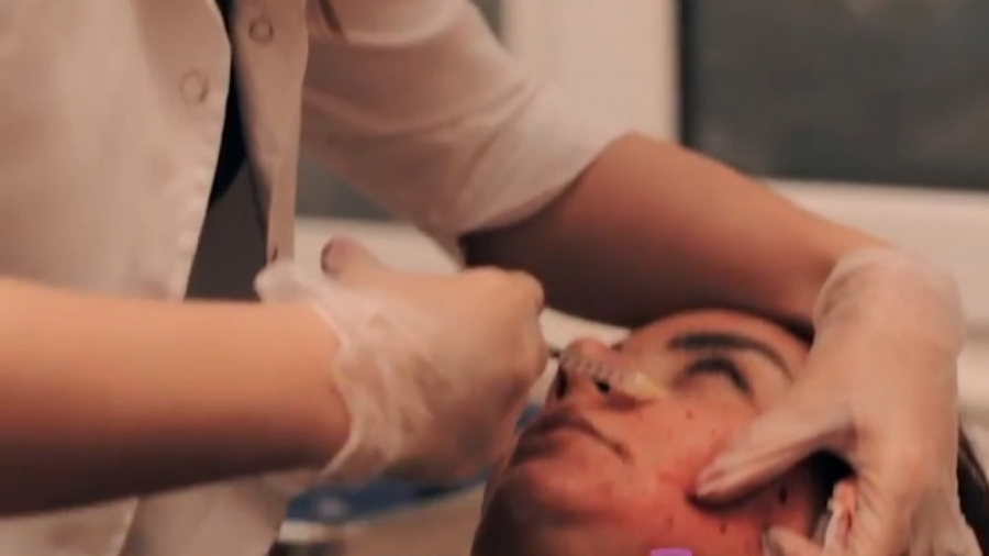 تزریق مزوتراپی با هدف جوانسازی، آبرسانی و روشن سازی و شفافیت پوست بیماری بهجت