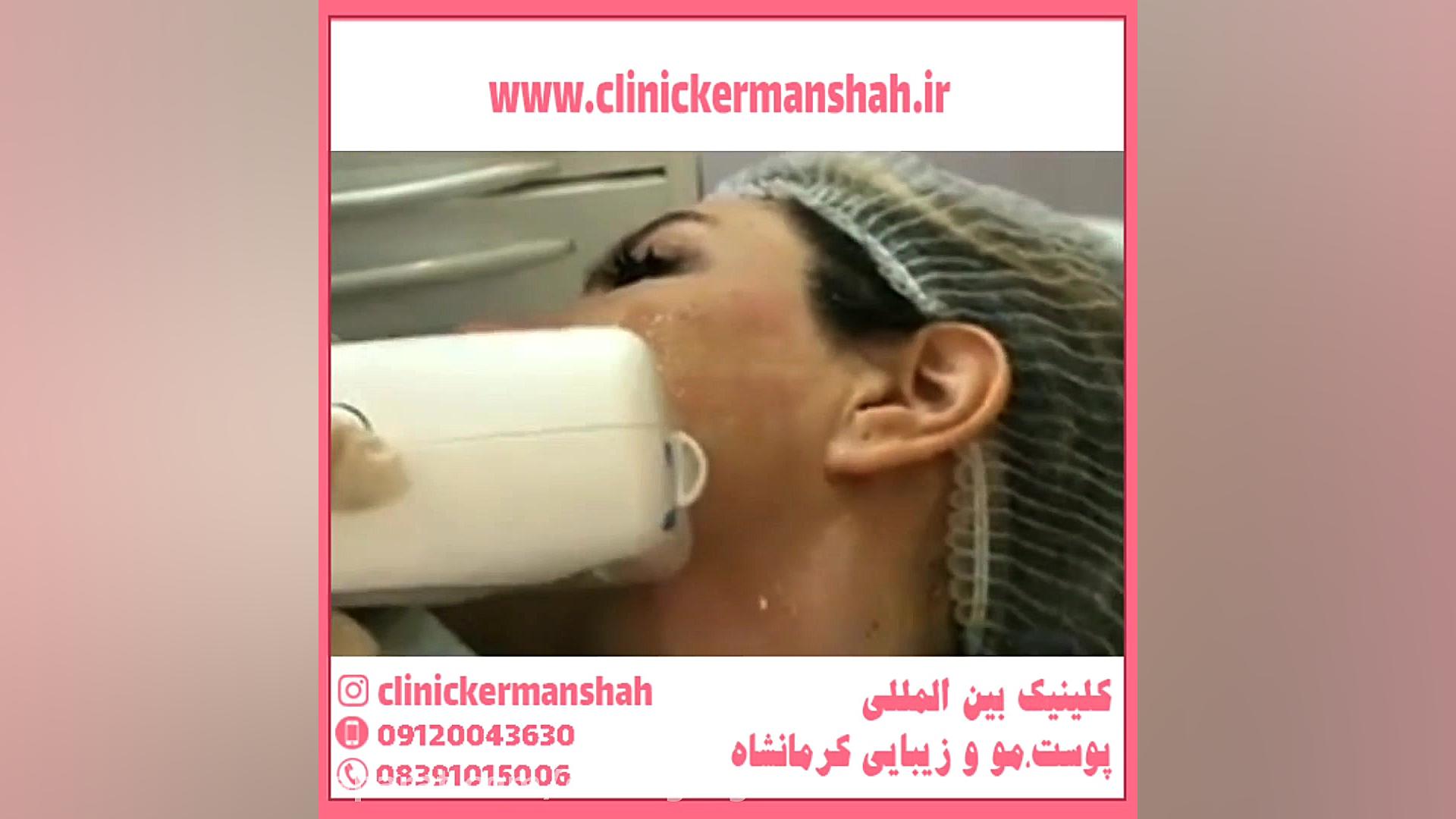 مراقبت های بعد از هایفوتراپی Microarray