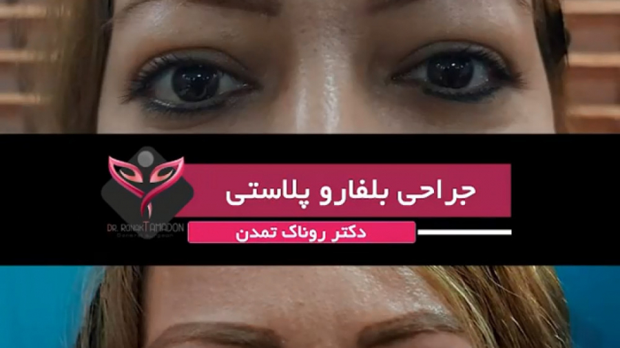 فیلم جراحی پلک ( بلفاروپلاستی ) کلینیک دندانپزشکی