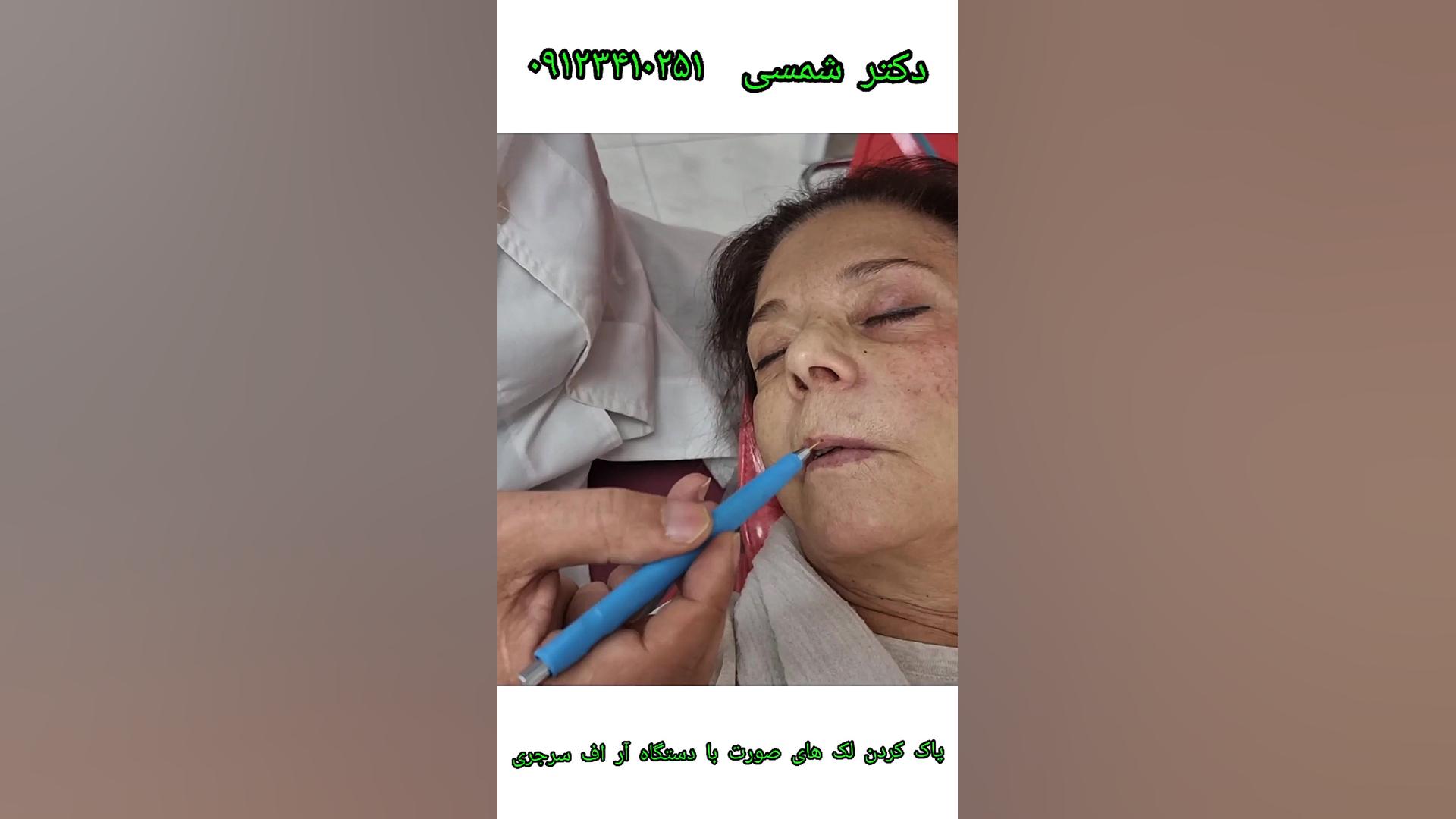 برداشتن خال ، زگیل اسکین تگ ، کک و مک لک صورت مزوتراپی