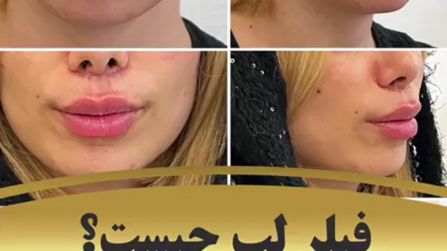 فیلر لب چیست ؟ دکتر بهزاد انوش|متخصص و جراح پوست مو زیبایی و لیزر