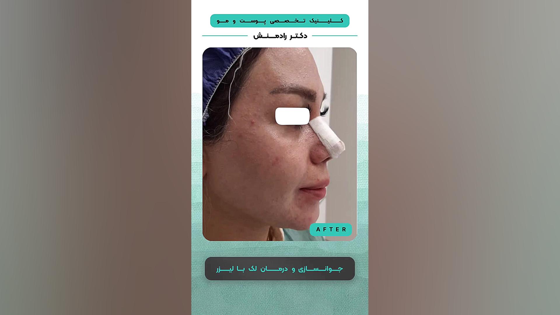 جوانسازی و درمان لک با لیزر تزریق بوتاکس