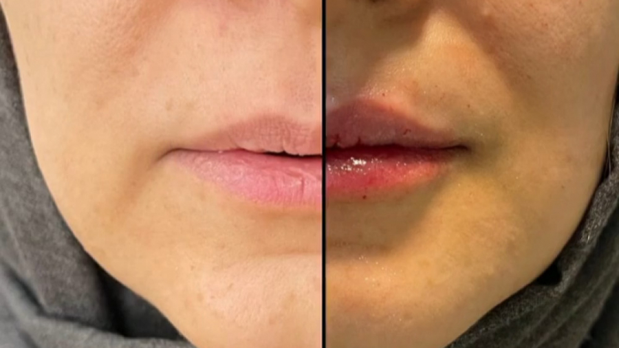 برجستگی لب بر روی چهره چه تاثیری دارد؟ دکتر سار ا لطفی