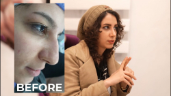 18 روز بعد از عمل بینی به روش...