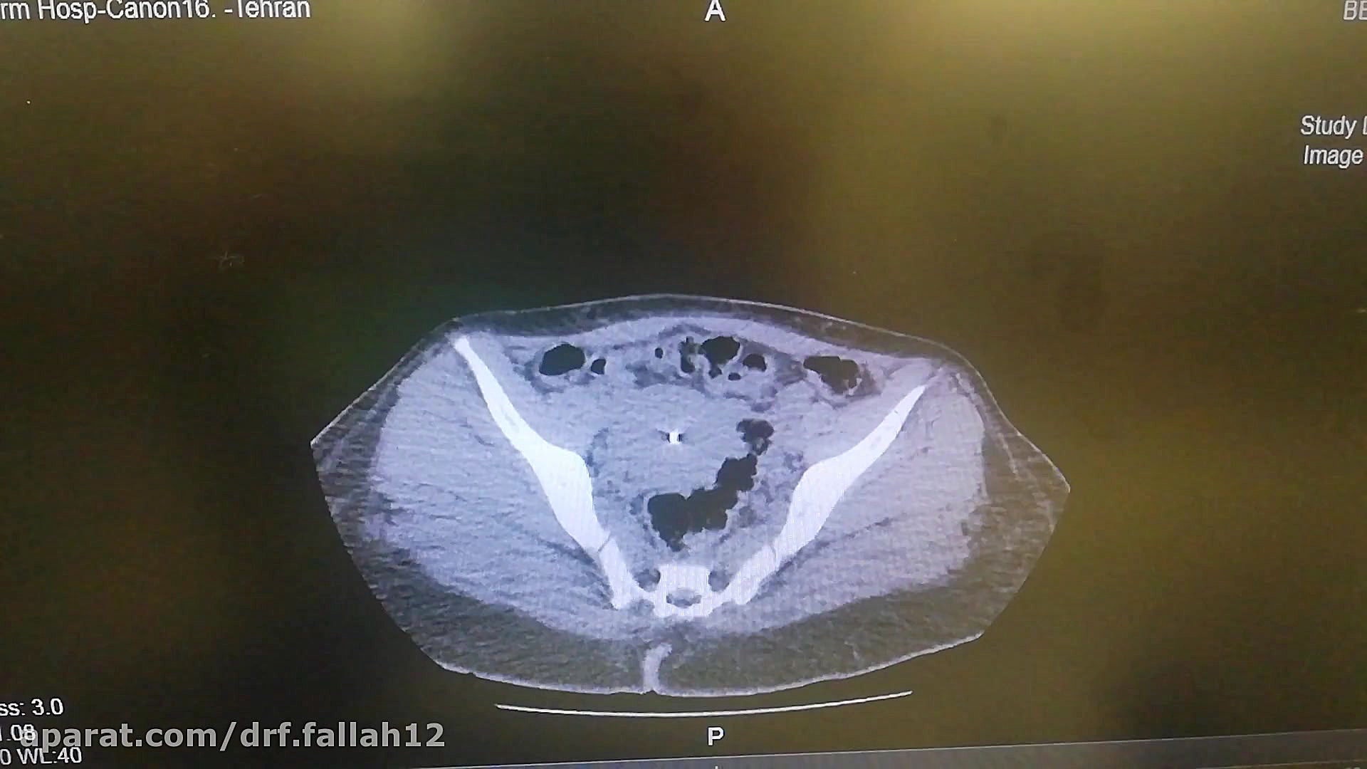 Abdominopelvic CT scan HIDA Scan
