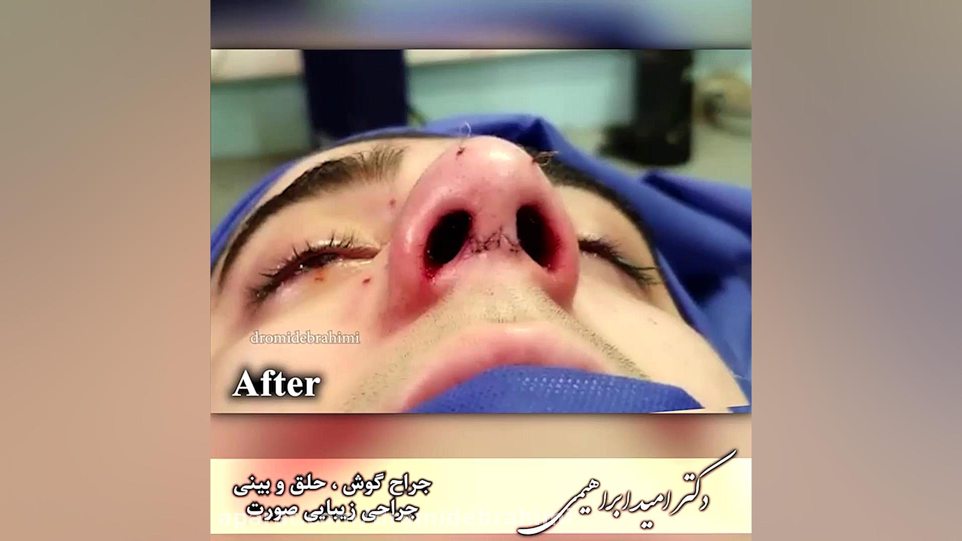 عمل طبیعی بینی استخوانی مردانه توسط دکتر امید ابراهیمی بهترین جراح بینی در تهران دکتر امید ابراهیمی