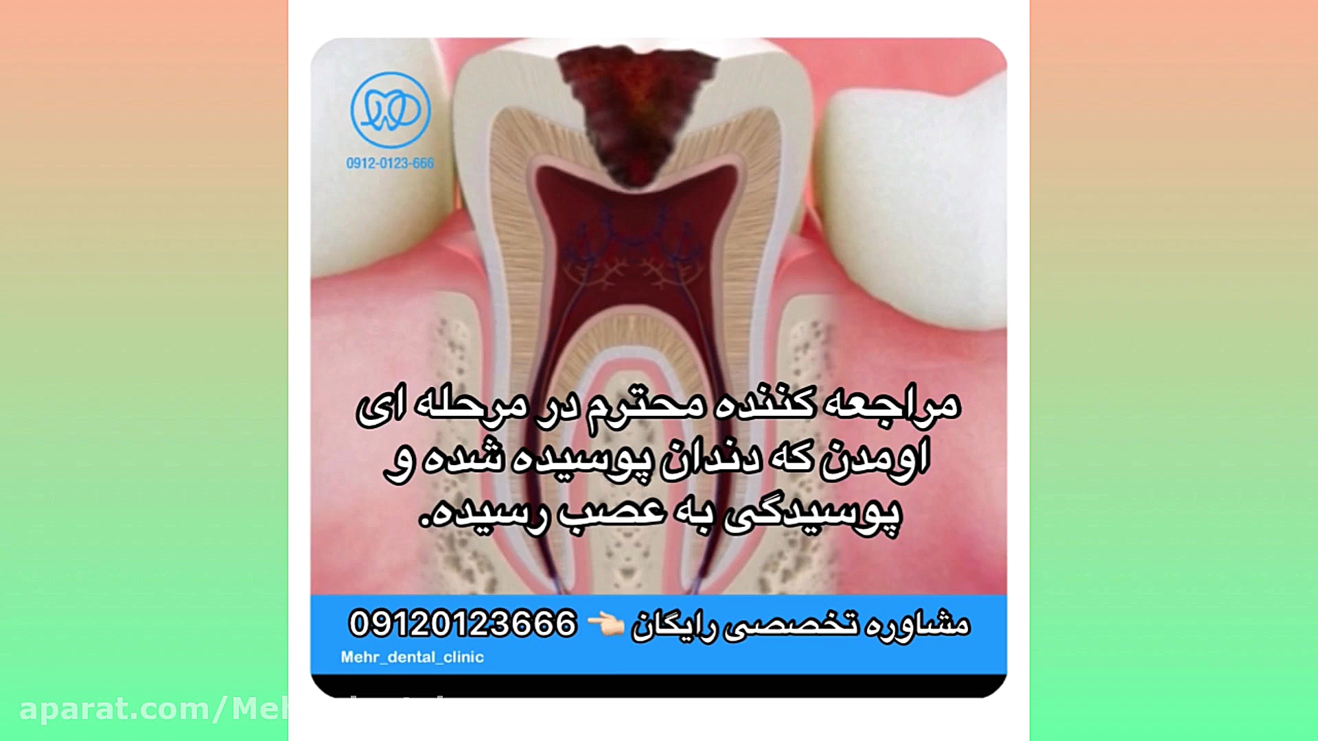 کلینیک دندانپزشکی مهر (mehr_dental_clinic) عصبکشی و روکش دندان بیماری آمیلوئیدوز فامیلیال
