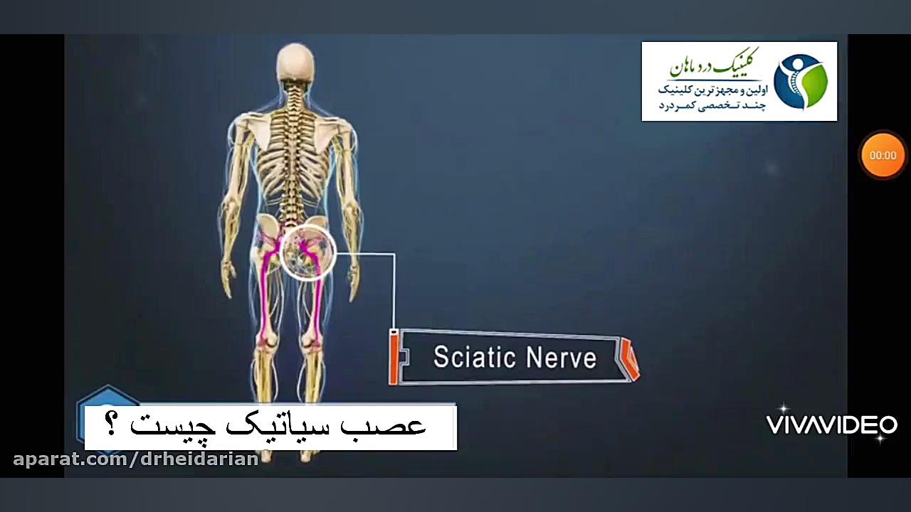 عصب سیاتیک چیست؟ پوسیدگی دندان