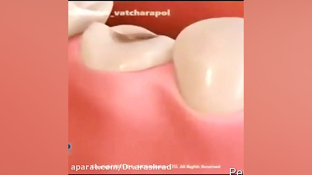 نحوه ساخت روکش برای دندان با نسج از دست رفته زیاد بیماری آسپارتیل گلوکوزامینوریا