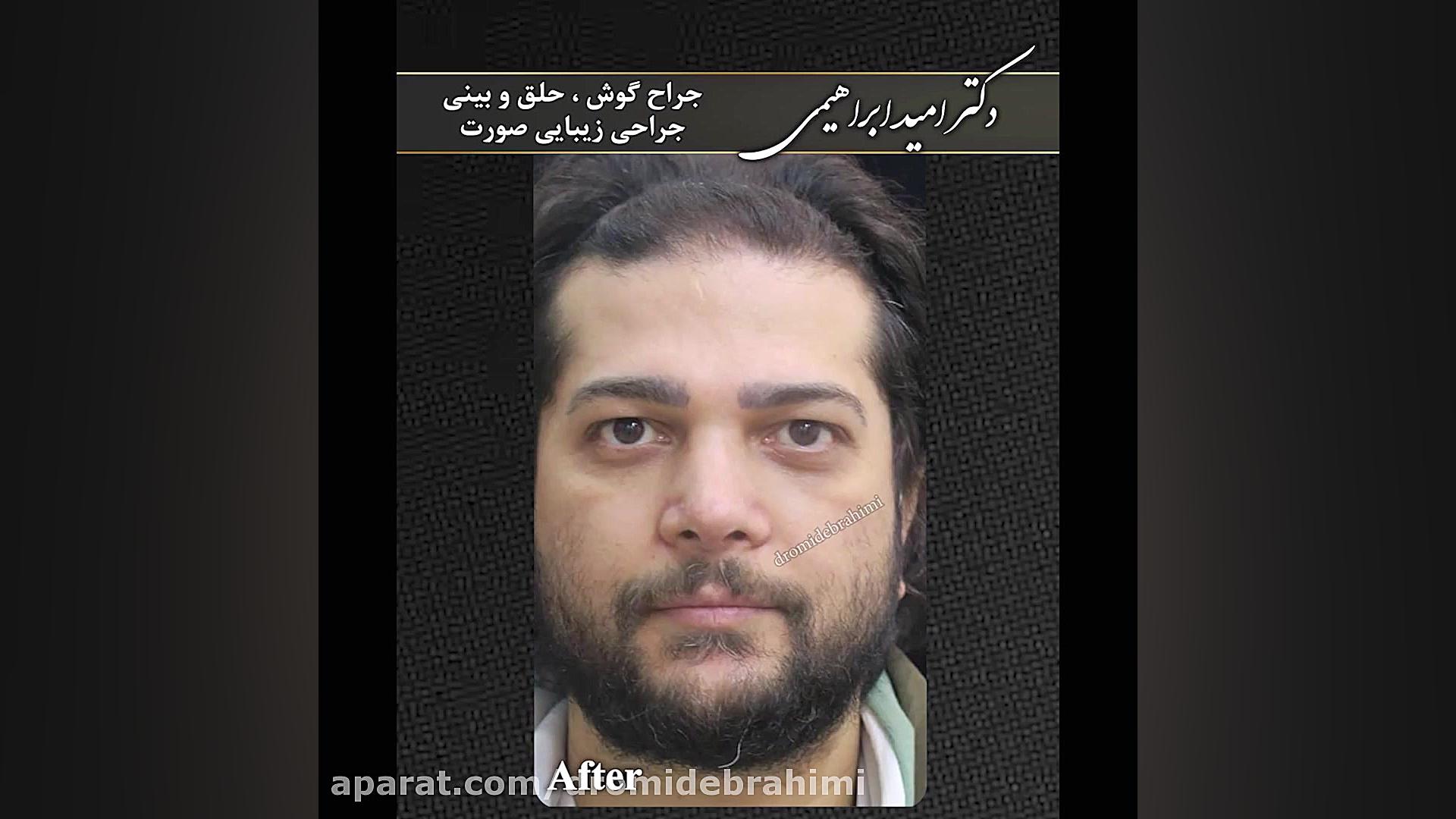 جراحی زیبایی بینی مردانه توسط دکتر امید ابراهیمی بهترین جراح بینی در تهران دکتر امید ابراهیمی