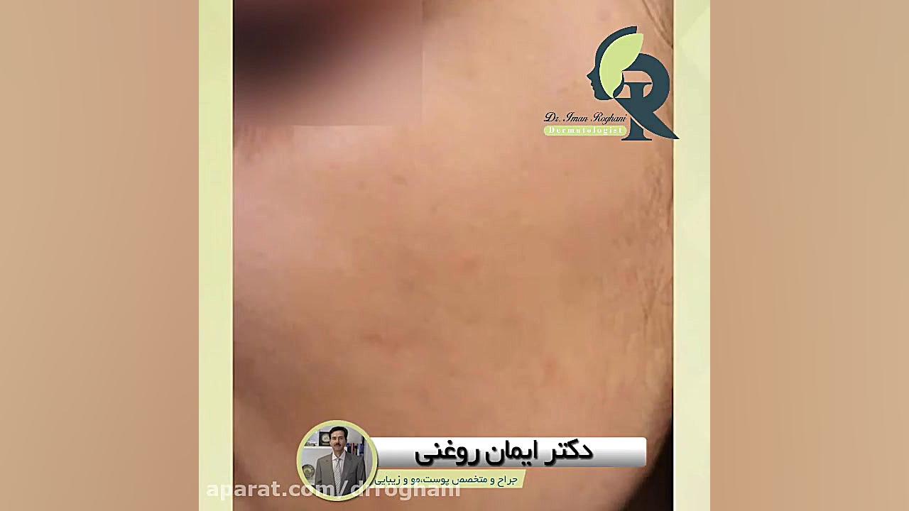 6ماه پس از درمان دارویی آکنه دکتر ایمان روغنی جراح و متخصص پوست و مو