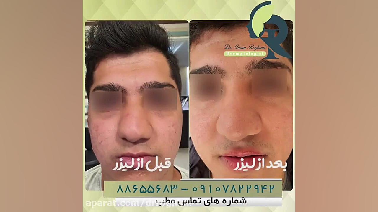بعد از انجام یک جلسه ترکیبی سابسیژن و لیزر Co2 دکتر ایمان روغنی جراح و متخصص پوست و مو