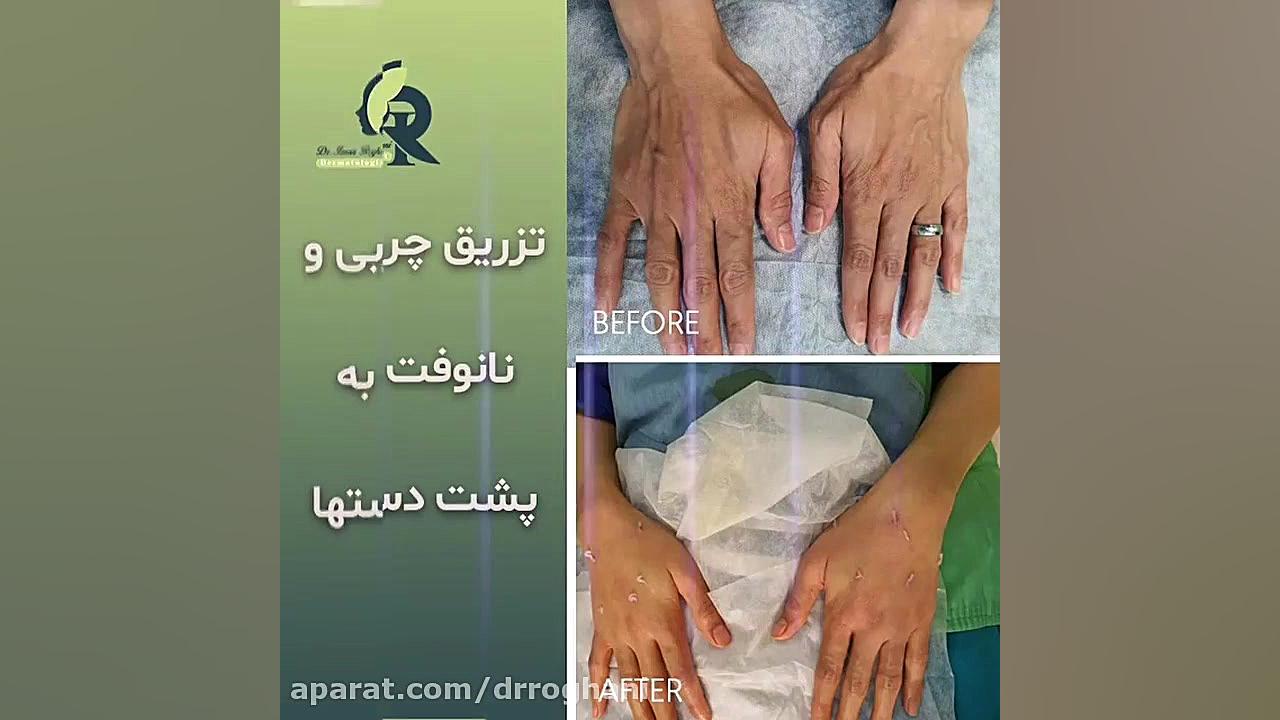 تزریق چربی به دست و نانوفت دکتر ایمان روغنی جراح و متخصص پوست و مو