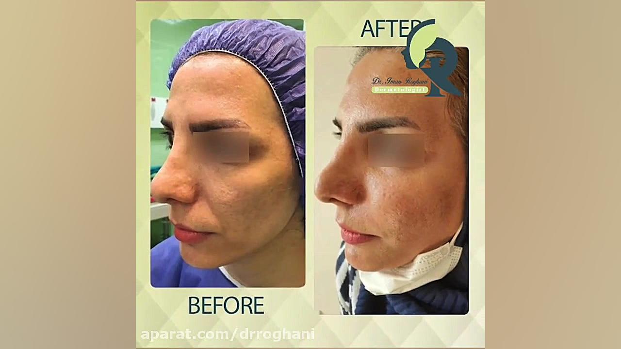 تزریق چربی جهت جوانسازی و ریمودلنیگ صورت دکتر ایمان روغنی جراح و متخصص پوست و مو
