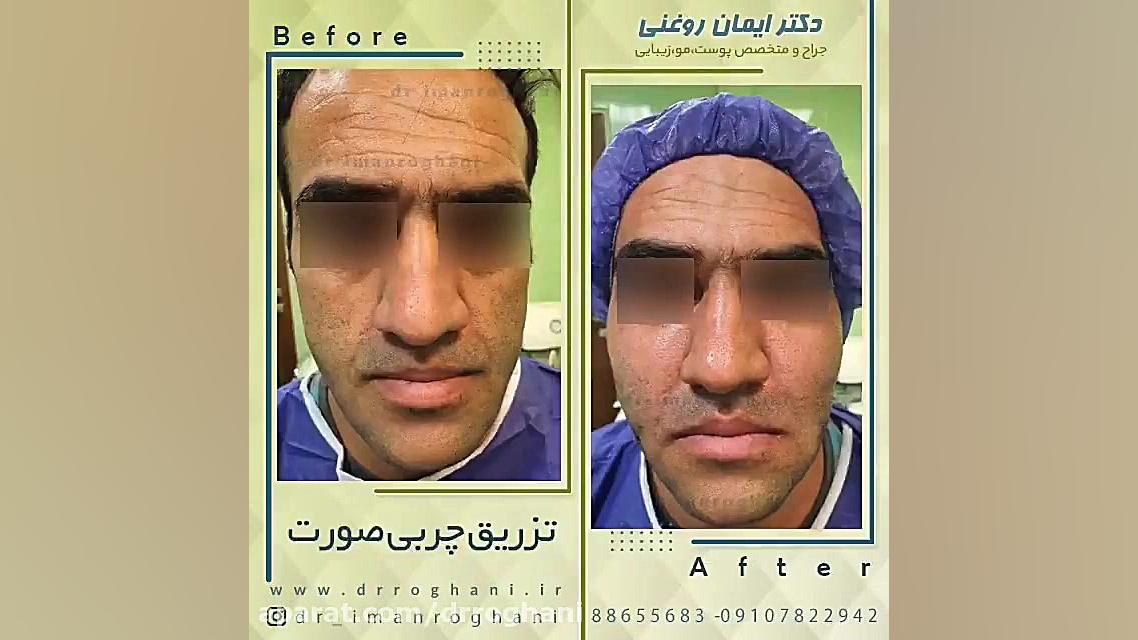 تزریق چربی صورت دکتر ایمان روغنی جراح و متخصص پوست و مو