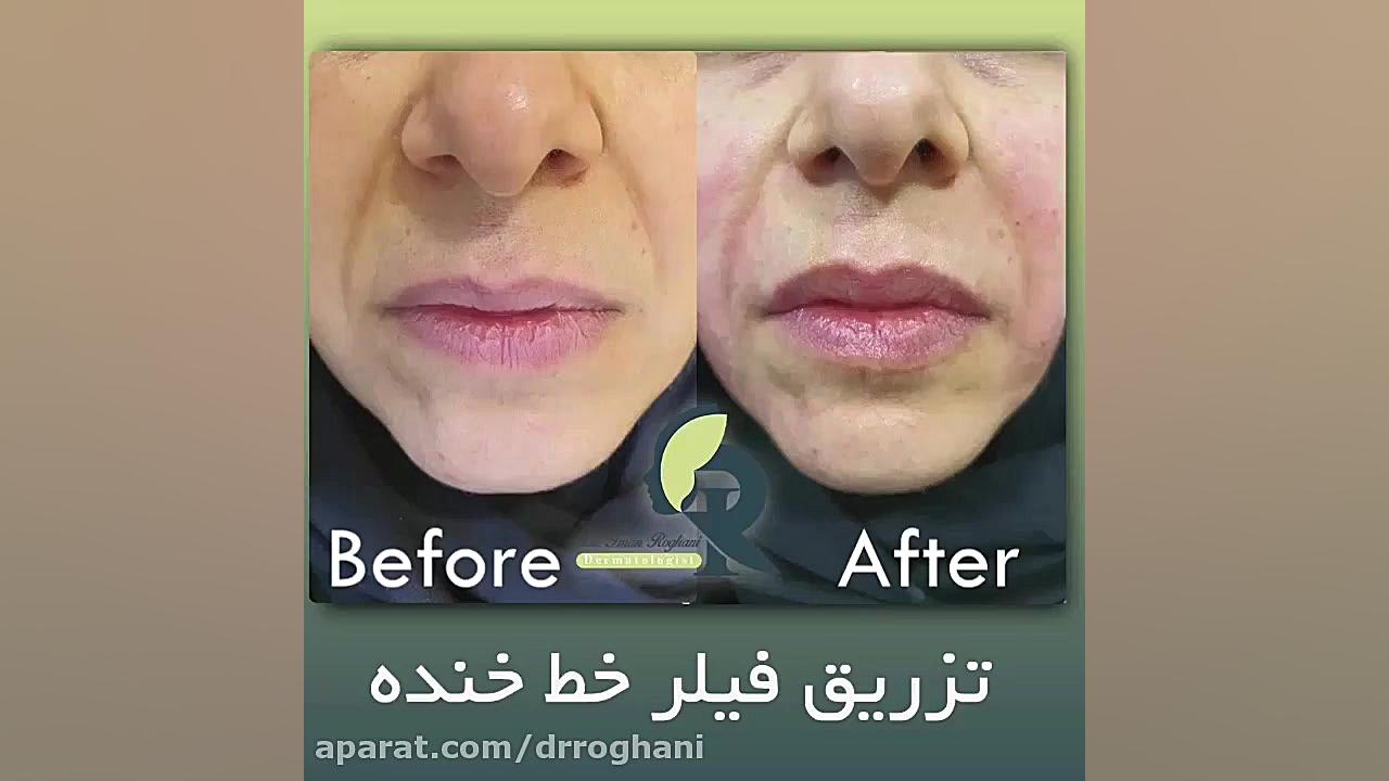 تزریق فیلر خط خنده دکتر ایمان روغنی جراح و متخصص پوست و مو