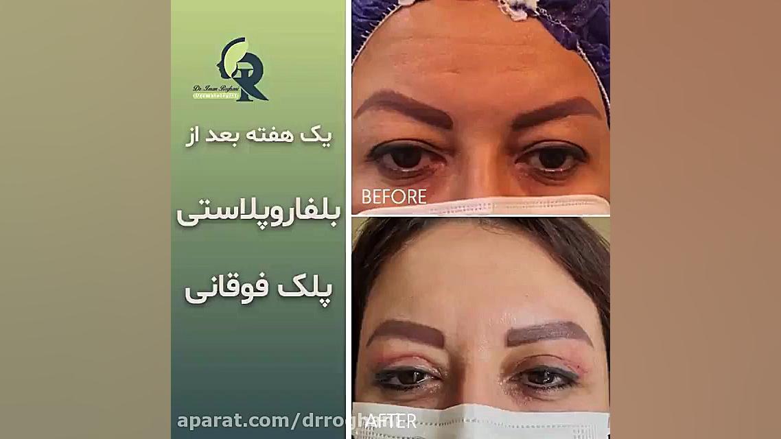یک هفته بعد از انجام بلفاروپلاستی پلک فوقانی دکتر ایمان روغنی جراح و متخصص پوست و مو