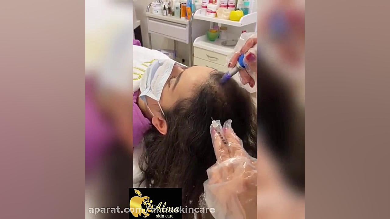 مزوتراپی مو در کلینیک زیبایی آلما در رشت پالپوتومی