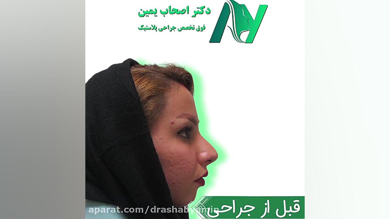 نمونه جراحی همزمان رینوپلاستی و ژنیوپلاستی دکتر محمودرضا اصحاب یمین - فوق تخصص پلاستیک