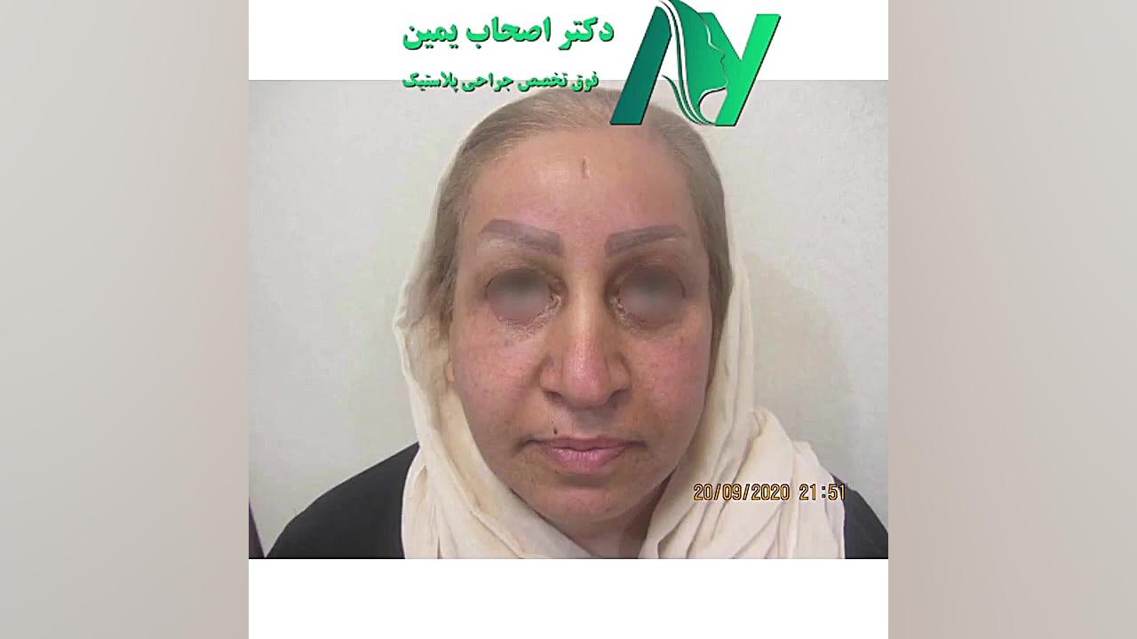 عمل لیفت کل صورت دکتر محمودرضا اصحاب یمین - فوق تخصص پلاستیک
