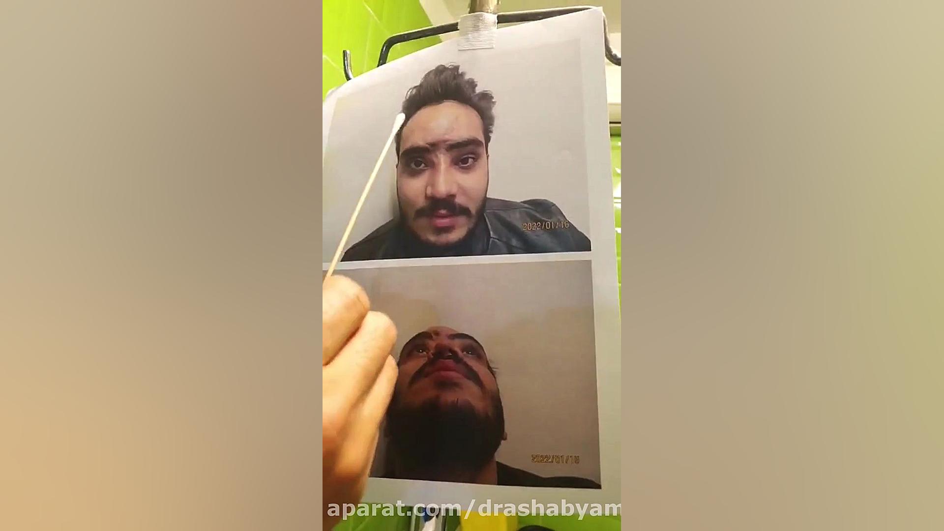 فیلم بدون سانسور بازسازی بینی با کمک غضروف دنده دکتر محمودرضا اصحاب یمین - فوق تخصص پلاستیک