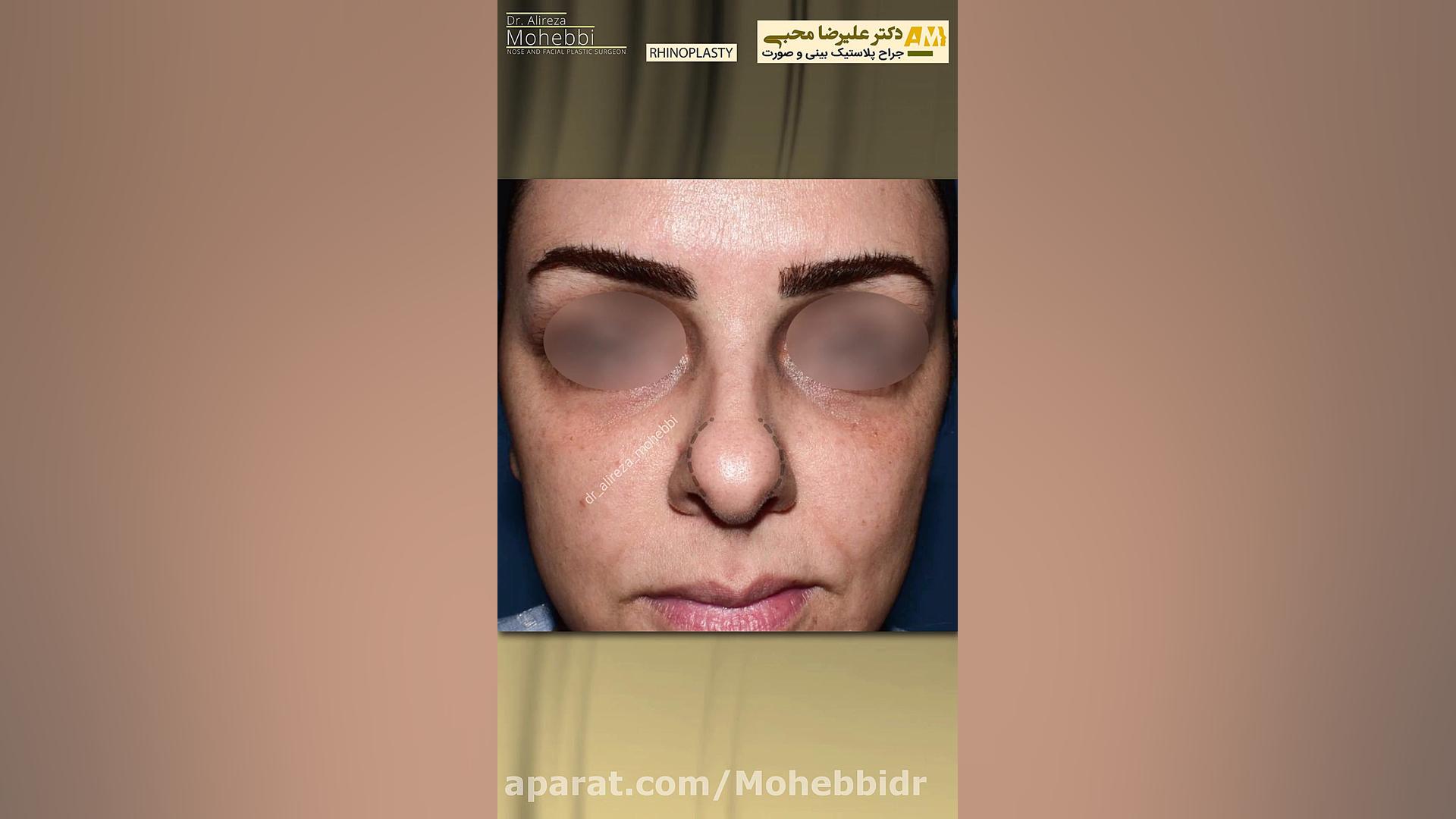 عمل زیبایی بینی گوشتی غضروفی باکسی تیپ تالاسمی دلتا-بتا