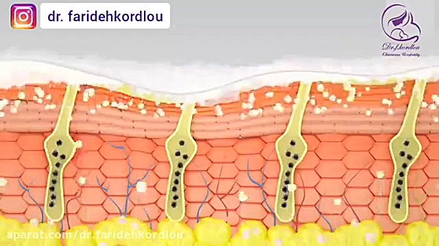 نحوه انجام کربوکسی تراپی کلینیک دندانپزشکیایمونولوژی پیوند