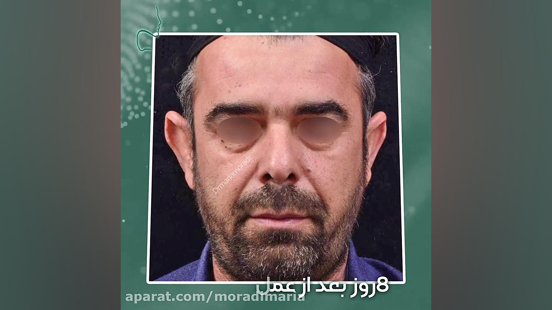 هشت روز پس از جراحی اتوپلاستی یا عمل زیبایی گوش کرانیوسینوستوز