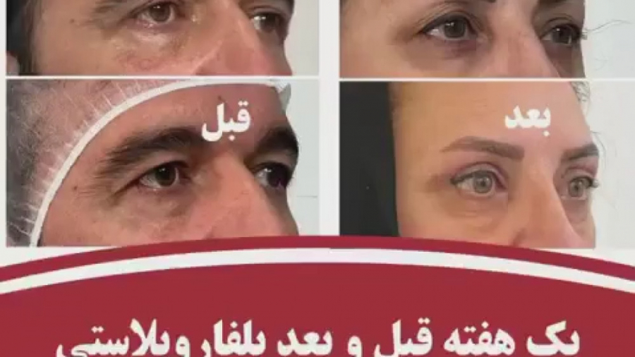 یک هفته قبل و بعد بلفاروپلاستی دکتر بهزاد انوش|متخصص و جراح پوست مو زیبایی و لیزر