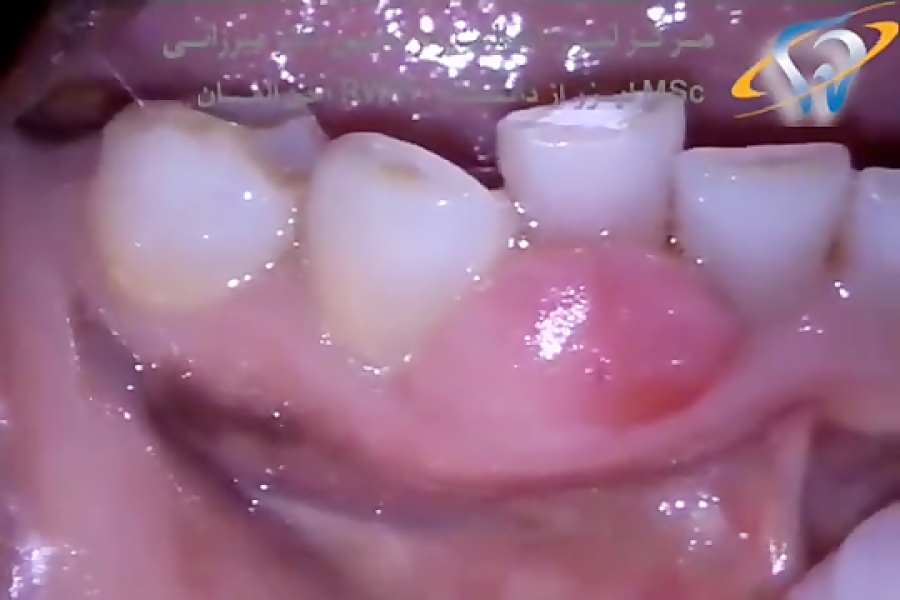 MD Epulis Removal