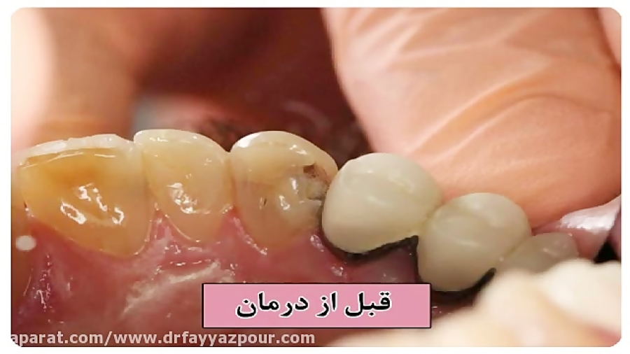 تراش دندان قدامی با لیزر و ترمیم با مواد همرنگ دندان علامت کرنیگ