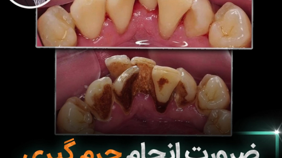 ضرورت انجام جرمگیری در بیماران ارتودنسی باند ضد باکتری نانو