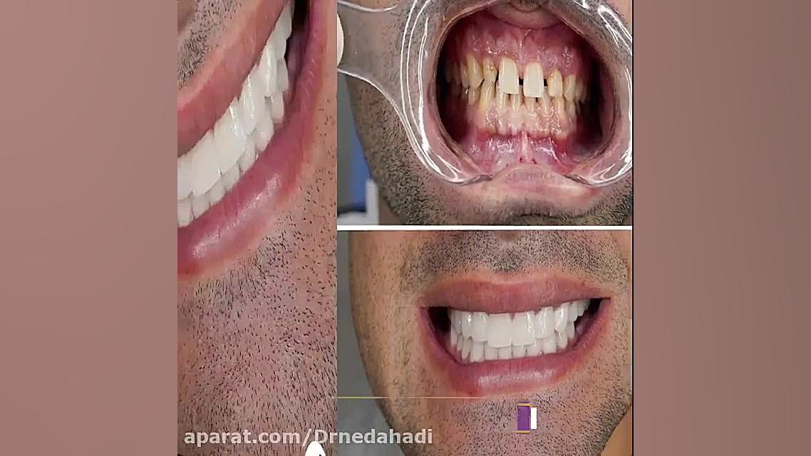فیلم واقعی لمینت دندان توسط دکتر ندا هادی دکتر ندا هادی-دندانپزشک زیبایی