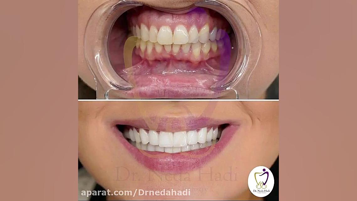 لمینت هر دو فک دندان با بهترین مواد دکتر ندا هادی-دندانپزشک زیبایی
