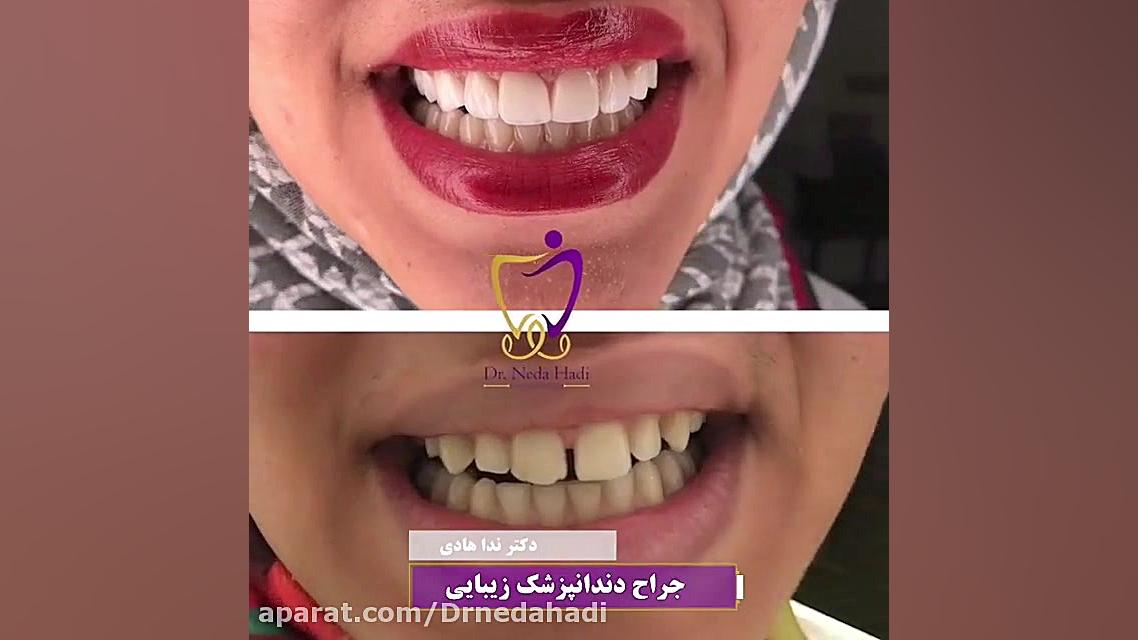 نتیجه لمینت هر دوفک دکتر ندا هادی-دندانپزشک زیبایی