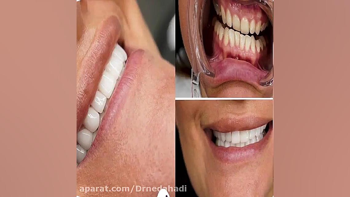 فیلم واقعی نتیجه لمینت دندان دکتر ندا هادی-دندانپزشک زیبایی