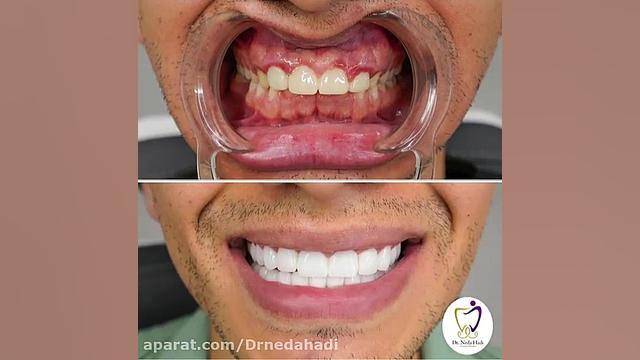 فیلم واقعی لمینت دندان دکتر ندا هادی دکتر ندا هادی-دندانپزشک زیبایی