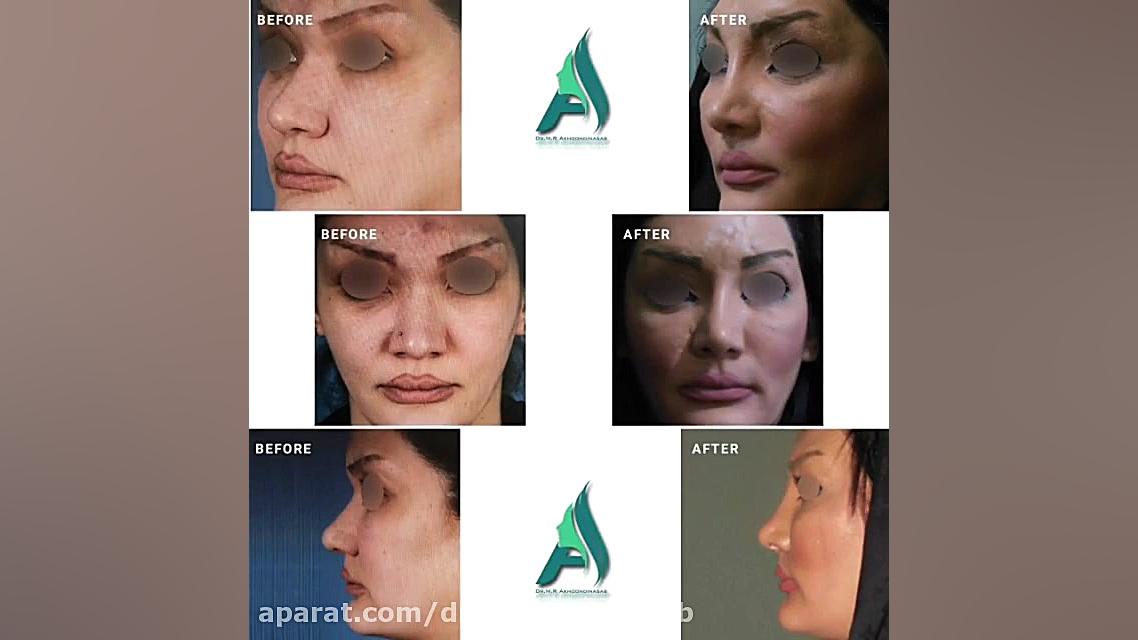 جراحی زیبایی بینی به روش آگمنتیشن و اصلاح فرم پیشانی دکتر محمدرضا آخوندی نسب-فوق تخصص جراحی پلاستیک